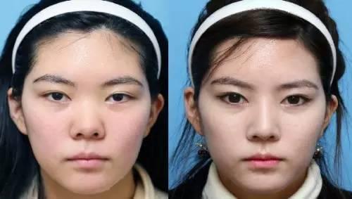 整容才能成网红吗